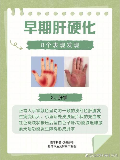 肝病都是拖出来的,一旦晨起有4个表现,是肝在“求救”,别大意!
