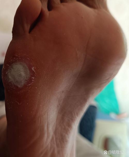 男子修脚不小心划破皮,结果右脚坏死……