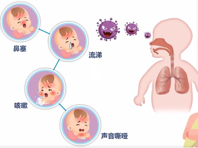 警惕!呼吸道合胞病毒更容易“盯上”孩子